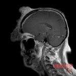 Patient with extensive facial cancer