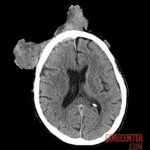 Patient with extensive facial cancer