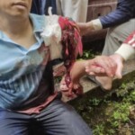 Bus passenger lost part of his arm in collision with truck