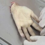 Vietnamese man lost his hand in machete attack