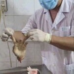 Vietnamese man lost his hand in machete attack