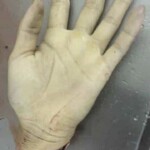 Vietnamese man lost his hand in machete attack