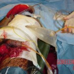 War injuries of soldiers from war in Iraq