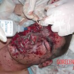 War injuries of soldiers from war in Iraq