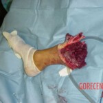 War injuries of soldiers from war in Iraq