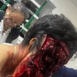 Motorcyclist tore his face in crash