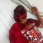 Motorcyclist tore his face in crash