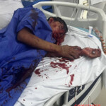 Motorcyclist tore his face in crash