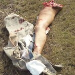 Collision with car tore off pedestrian's entire leg