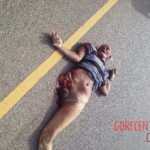 Collision with car tore off pedestrian's entire leg