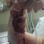 Injury caused by knife