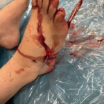 Injury caused by knife