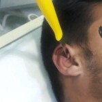 Injury caused by knife