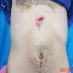 Injury caused by knife