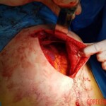 Injury caused by knife