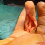 Injury caused by knife