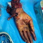 Surgical amputation of hand
