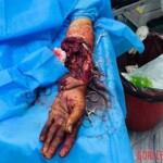 Surgical amputation of hand