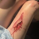 Young Vietnamese woman suffered leg injury in moped crash