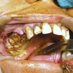 Massive necrosis after tooth extraction