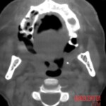 Massive necrosis after tooth extraction