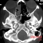 Massive necrosis after tooth extraction