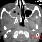 Massive necrosis after tooth extraction