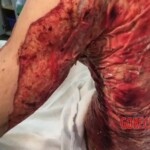 Severe burns caused by moped crash