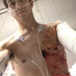 Severe burns caused by moped crash