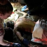 Severe burns caused by moped crash