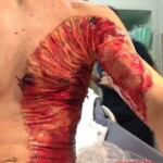 Severe burns caused by moped crash