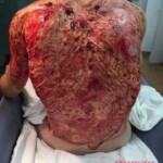 Severe burns caused by moped crash
