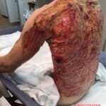 Severe burns caused by moped crash