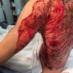 Severe burns caused by moped crash