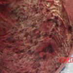 Severe burns caused by moped crash