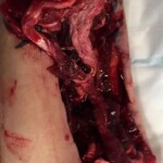 Woman mutilated and chewed her own forearm