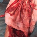 Woman mutilated and chewed her own forearm