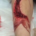 Young American woman nearly lost her leg in shark attack