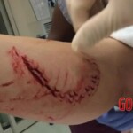 Young American woman nearly lost her leg in shark attack