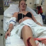Young American woman nearly lost her leg in shark attack