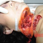 Chinese woman with deep wound on her neck