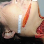 Chinese woman with deep wound on her neck