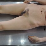 Chinese woman in morgue