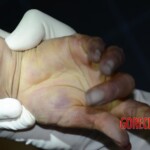 Initial forensic examination of strangled Chinese woman