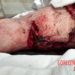 Legs destroyed in traffic accident