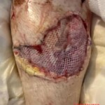 Legs destroyed in traffic accident