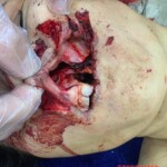 Woman died after sustaining fatal intraoral gunshot wound