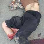 Young Cambodian woman lost her leg in collision with car