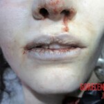 Young woman committed suicide using sodium nitrate and sodium nitrite