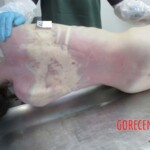 Young woman committed suicide using sodium nitrate and sodium nitrite